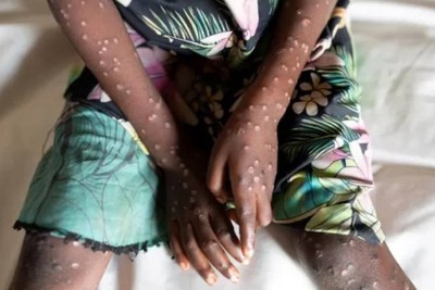 UNICEF wants 58.8 million dollars to stop the mpox outbreak in Africa