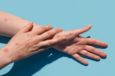 The UK has recorded the first case of monkey fever outside of Africa